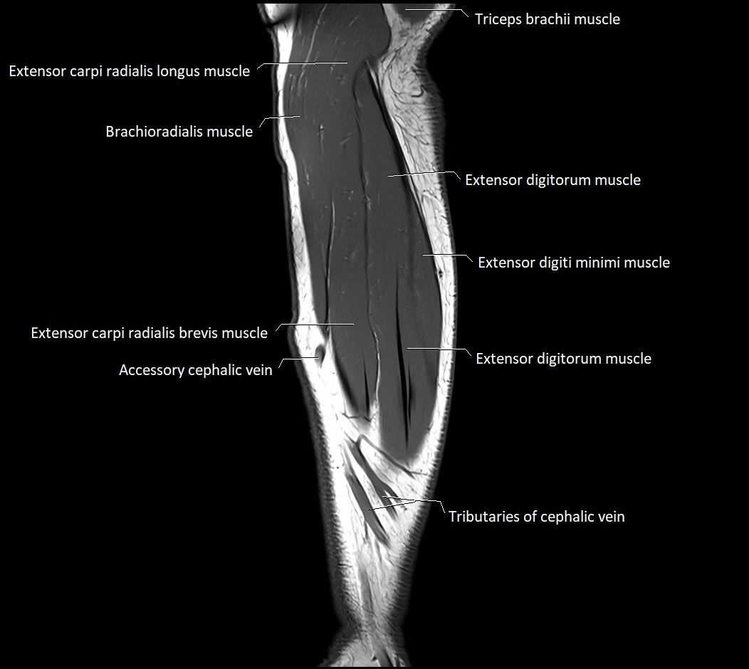 MRI 3T forearm sagittal labelled cross sectional anatomy image 11.webp